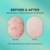 51hVWDU64fL._SL1000_.jpg Butt Acne Cream | Buttocks Acne Lotion for Body Blemishes | Body Acne Cream Formulated with Natural Formula | Butt Acne Clearing Treatment Lotion | Butt Acne Spot Cream Targeting Stubborn Blemishes