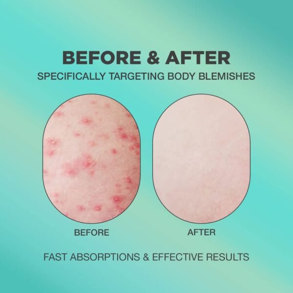 51hVWDU64fL._SL1000_.jpg Butt Acne Cream | Buttocks Acne Lotion for Body Blemishes | Body Acne Cream Formulated with Natural Formula | Butt Acne Clearing Treatment Lotion | Butt Acne Spot Cream Targeting Stubborn Blemishes