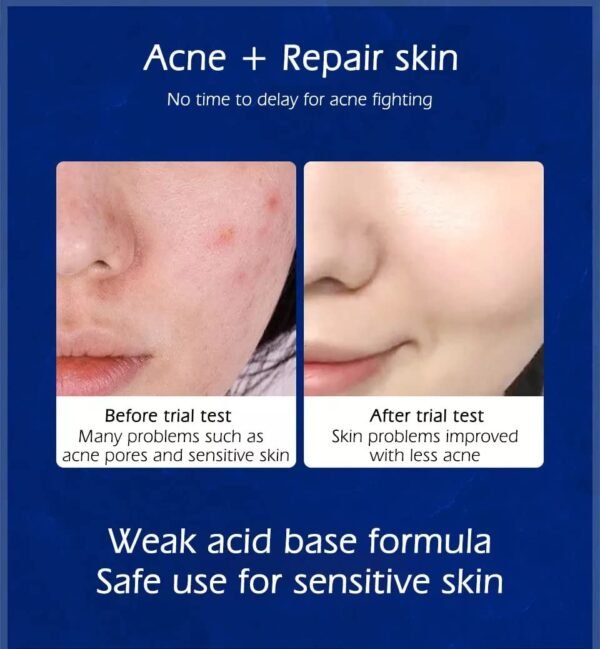 61BmKU4aUVL._SL1038_.jpg Cystic, Hormonal, Severe Acne Cream for Teens & Adults with Hyaluronic Acid Aloe Vera Oil Cystic , Unisex Sensitive Skin Blind Pimple & Blemish (1 PACK)