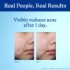 61fmXp7dWL._SL1500_.jpg Differin Acne Spot Treatment with 10% Benzoyl Peroxide, Maximum Strength OTC Acne Treatment, Fast Acting Spot Treatment for Face, 1 oz