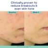 716AA9QuMtL._SL1500_.jpg Cetaphil Gentle Clear Triple-Action Acne Treatment Serum with Salicylic Acid, Treats and Prevents Acne, Great for Post-Acne Marks, for All Skin Types, 1oz