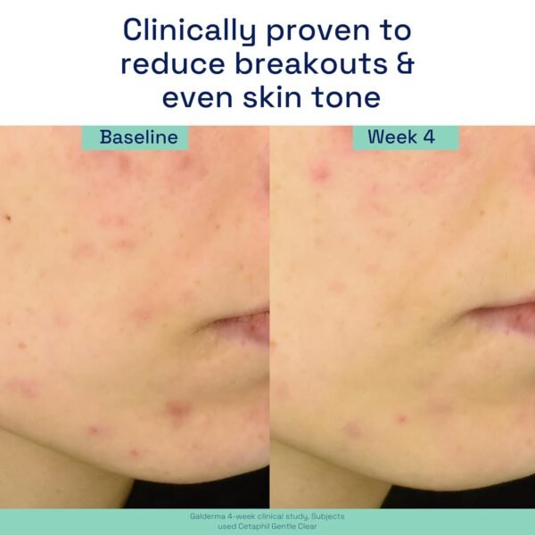 716AA9QuMtL._SL1500_.jpg Cetaphil Gentle Clear Triple-Action Acne Treatment Serum with Salicylic Acid, Treats and Prevents Acne, Great for Post-Acne Marks, for All Skin Types, 1oz