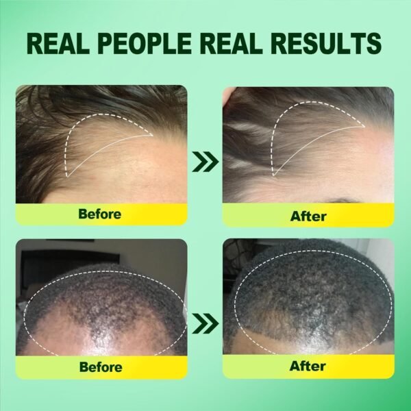 5% Minoxidil for Men, 2PCS Minoxidil for Women Hair Growth Products, Extra Strength Minoxidil Topical Hair Loss Regrowth Treatment Serum with Rosemary & Biotin, Upgraded formula light & Non-Greasy