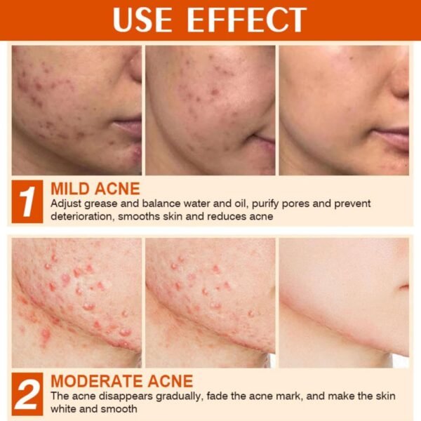 Acne Cream Pimple Cream for Face, Oil Control Pimple Remover Cream Get Rid of Pimples Fast,for Oily and Acne Prone Skin, Cruelty Free, Crema para espinillas en la cara