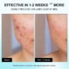 71DeTzhVWfL._SL1500_.jpg Enaskin Naturals Acne Pimple Spot Treatment Cream: Cystic Hormonal Blackheads Blemish Remover for Face, Back and Body - with 10% Azelaic Acid - Teens 13-19 & Young Adult 20-30, 1.8 oz