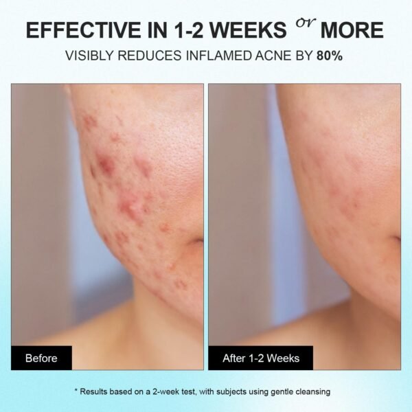 71DeTzhVWfL._SL1500_.jpg Enaskin Naturals Acne Pimple Spot Treatment Cream: Cystic Hormonal Blackheads Blemish Remover for Face, Back and Body - with 10% Azelaic Acid - Teens 13-19 & Young Adult 20-30, 1.8 oz