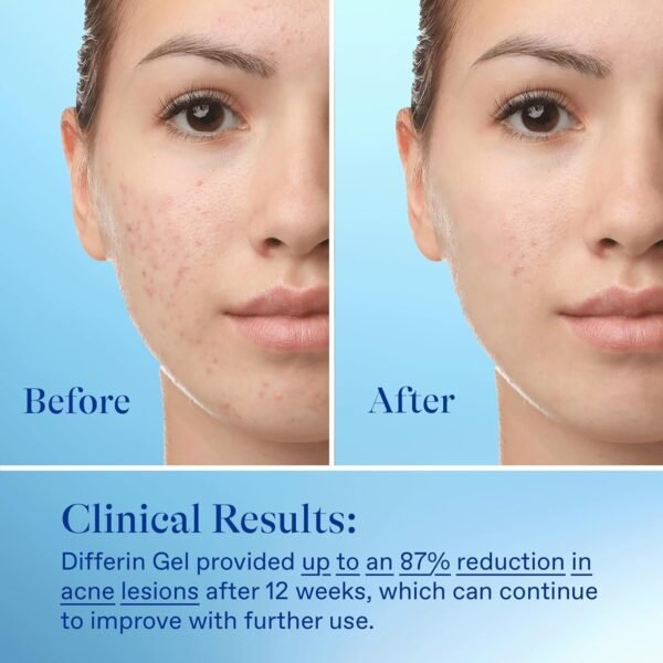 Differin Acne Treatment Gel, 30 Day Supply, Retinoid Treatment for Face with 0.1% Adapalene, Gentle Skin Care for Acne Prone Sensitive Skin, 15g Tube (Packaging May Vary)