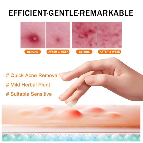 Acne Cream, Acne Spot Cream for Face and Body, Pimple Cream Spot, Reduce Cystic AcNe for Face, Back & Butt AcnE Clearing CreaM for Teens & Adults