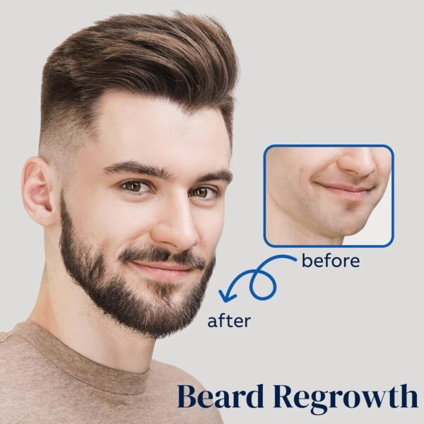 5% Minoxidil Spray for Men and Women, Minoxidil for Women Hair Growth, Minoxidil for Men Hair Growth Spray 2PCS.