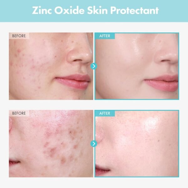 71NHHzwlRrL._SL1500_.jpg SOS Repair CICA Clinic Zinc Cream, 100,000ppm Zinc Oxide, Heal, Soothe Acne, Redness, Rosacea Treatment, Skin Barrier Repair, Moisture, Non-Comedogenic, Korean Skin care, 50g, 1.76 oz.