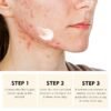 Acne Treatment for Face for Hormonal Cystic Stubborn Acne Cream for Sensitive Skin Teens Adults Women Men Spot Pimple Butt Control Rapid Clearing Breakout Overnight Face Blemish Treatment Moisturizer