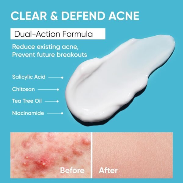 Butt Acne Clearing Treatment Cream: Clears & Prevents Breakouts Fast – Gentle Body & Back Lotion for Clogged Pores, Folliculitis & Bumps, 2% Salicylic Acid & Niacinamide, Ideal for Women, Men & Teens