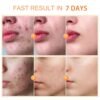 Acne Cream, Acne Spot Cream for Face and Body, Pimple Cream Spot, Reduce Cystic AcNe for Face, Back & Butt AcnE Clearing CreaM for Teens & Adults
