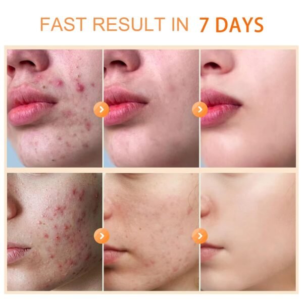 Acne Cream, Acne Spot Cream for Face and Body, Pimple Cream Spot, Reduce Cystic AcNe for Face, Back & Butt AcnE Clearing CreaM for Teens & Adults