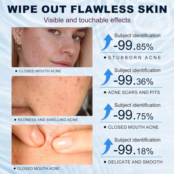 71iybwxkz5L._SL1500_.jpg Azelaic Acid 10% Cream for Face - Acne Cream for Rosacea Reducing Relief Pimple Breakouts Blackhead Pigmentation and Redness - Azelaic Acid Gel For Facial and Skin Care