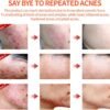 Acne Cream Pimple Cream for Face, Oil Control Pimple Remover Cream Get Rid of Pimples Fast,for Oily and Acne Prone Skin, Cruelty Free, Crema para espinillas en la cara