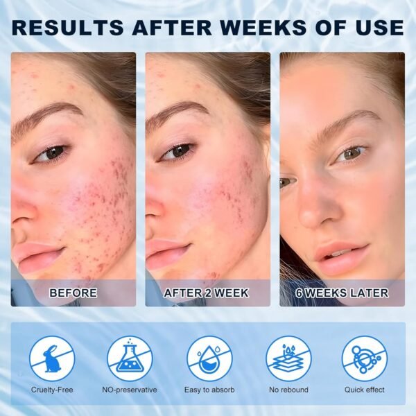 71tuvbLLLwL._SL1500_.jpg Azelaic Acid 10% Cream for Face - Acne Cream for Rosacea Reducing Relief Pimple Breakouts Blackhead Pigmentation and Redness - Azelaic Acid Gel For Facial and Skin Care