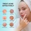 71ueZdJCTOL._SL1500_.jpg Enaskin Naturals Acne Pimple Spot Treatment Cream: Cystic Hormonal Blackheads Blemish Remover for Face, Back and Body - with 10% Azelaic Acid - Teens 13-19 & Young Adult 20-30, 1.8 oz