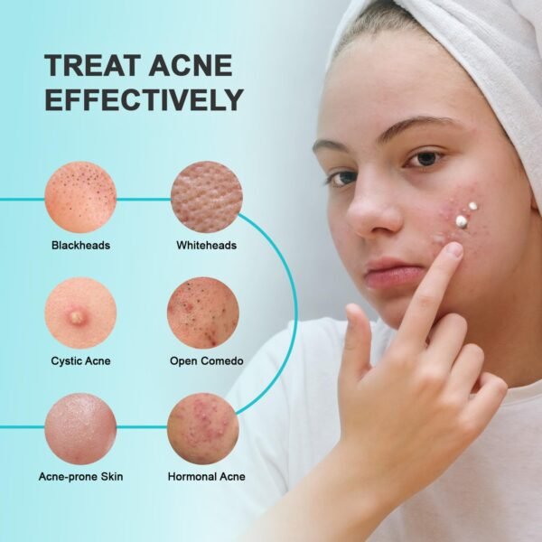71ueZdJCTOL._SL1500_.jpg Enaskin Naturals Acne Pimple Spot Treatment Cream: Cystic Hormonal Blackheads Blemish Remover for Face, Back and Body - with 10% Azelaic Acid - Teens 13-19 & Young Adult 20-30, 1.8 oz