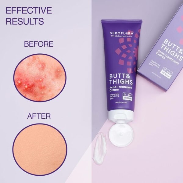 71vUOmqKHUL._SL1500_.jpg Butt & Thighs Acne Treatment Cream - Butt Acne Clearing Cream for Pimples, Zits, Razor Bumps, Dark Spots - Acne Clearing Lotion for Buttocks & Body - Inner Thigh Blackhead Remover (4oz)