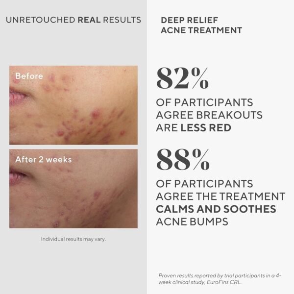 Murad Deep Relief Acne Treatment - Maximum Strength Acne Treatment with 2% Salicylic Acid and Phytosteroid for Deep, Painful Acne Breakouts and Redness - Accelerated Healing Treatment - 1 Fl Oz