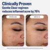 813aEiUS0PL._SL1500_.jpg Cetaphil Face Moisturizer, Gentle Clear Mattifying Acne Moisturizer With 0.5% Salicylic Acid, Hydrates and Treats Sensitive Acne Prone Skin, Skin Care for Sensitive Skin, 3oz