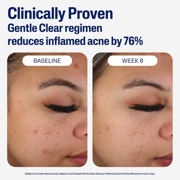 813aEiUS0PL._SL1500_.jpg Cetaphil Face Moisturizer, Gentle Clear Mattifying Acne Moisturizer With 0.5% Salicylic Acid, Hydrates and Treats Sensitive Acne Prone Skin, Skin Care for Sensitive Skin, 3oz