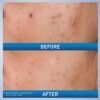 815qvKgb03L._SL1500_.jpg CeraVe Acne Control Gel, 2% Salicylic Acid Treatment With Glycolic Acid + Lactic Acids + Niacniamide, Acne Gel Helps Clear Blemishes Without Over Drying, Alcohol Free & Oil Free, 1.35 Fl Oz
