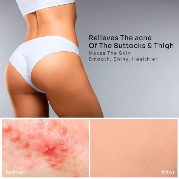 816x-4vMdL._SL1500_.jpg Butt Acne Clearing Treatment Cream: Body Acne Treatment Lotion for Folliculitis and Pimples on Back, Buttocks, Thighs With 2% Salicylic Acid & Tea Tree Oil - Butt Cream for Smooth Skin
