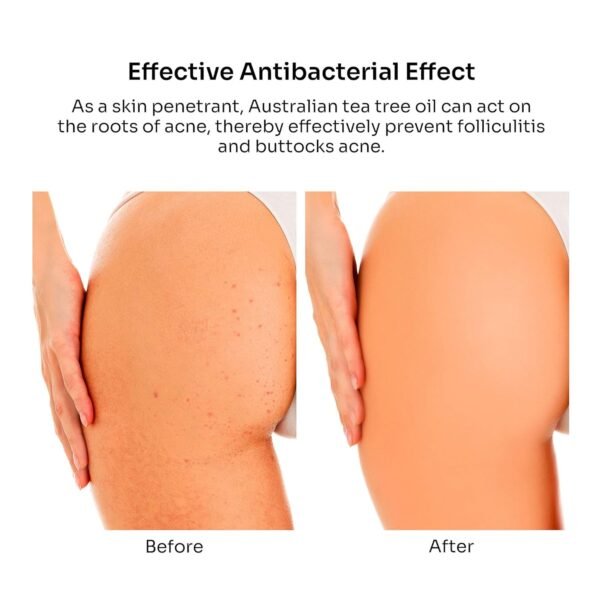 81EFTe3Tc1L._SL1500_.jpg Butt Acne Clearing Treatment Cream: Body Acne Treatment Lotion for Folliculitis and Pimples on Back, Buttocks, Thighs With 2% Salicylic Acid & Tea Tree Oil - Butt Cream for Smooth Skin