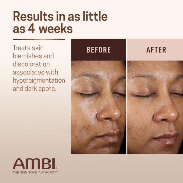 81OWVOtFnL._SL1500_.jpg Ambi Even & Clear Advanced Fade Cream, Hydroquinone-free, Hyperpigmentation Treatment, Stubborn Dark Spot Corrector, Results In As Little As 2-3 Weeks, Niacinamide, Licorice Root Extract, PHA, 1 Fl Oz