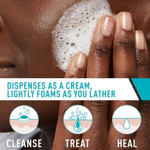 81jV8hZEadL._SL1500_.jpg CeraVe Acne Foaming Cream Cleanser, 4% Benzoyl Peroxide Face Wash With Hyaluronic Acid, Niacinamide & Ceramides, Gentle Daily Acne Treatment For Face