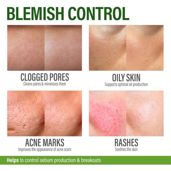 Acne Treatment Face Cream - Acne Spot Treatment for Face & Acne Dots - Tea Tree Oil for Acne - Natural Cystic Acne Treatment -Made in USA- For All Skin Types - Acne Scar Cream & Pimple Remover 4 fl.oz