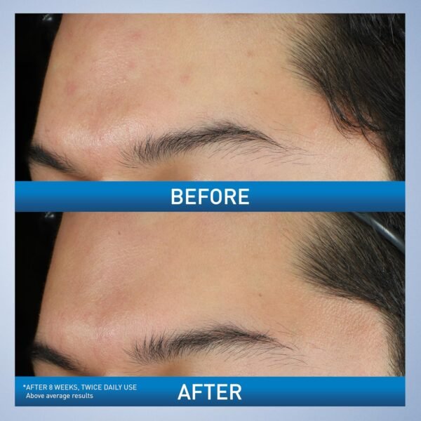 CeraVe Acne Foaming Cream Wash, Gentle Face and Body Cleanser with Benzoyl Peroxide 10%, Hyaluronic Acid, and Niacinamide, 10% Benzoyl Peroxide Treatment Clears Pimples and Blackheads 5 Oz