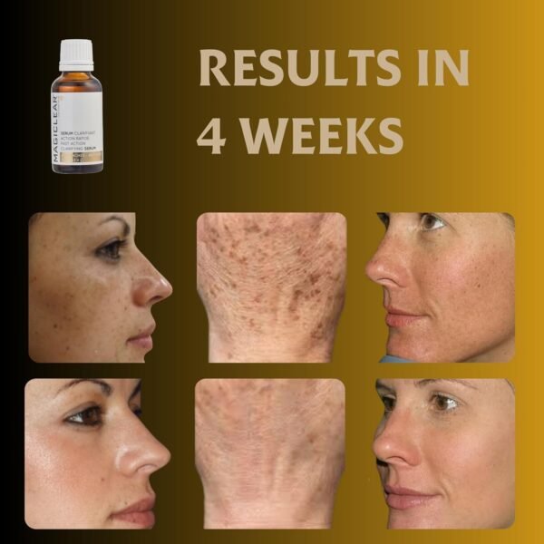 Luxury Swiss Dark Spot Remover for Face and Body Serum Age Sun Brown Spot Acne Freckles Corrector Melasma treatment Anti aging Skin Vitamin C + Niacinamide best organic brand Magiclear