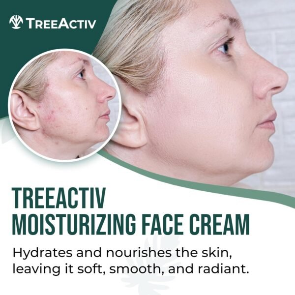 71o8c28fL._SL1500_.jpg TreeActiv Acne Eliminating Face Cream | Best Natural Extra Strength Fast Acting Treatment for Clearing Facial Acne | Gentle Enough for Sensitive Skin, Adults, Teens, Men, Women | Tea Tree | 2 fl oz