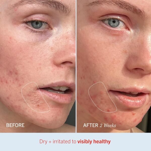 First Aid Beauty - Ultra Repair Cream, Intense Hydration Whipped Colloidal Oatmeal, Clinically Proven to Strengthen Skin Barrier in 7 Days & Helps Relieve Eczema, Luxury Face & Body Moisturizer, 6 oz