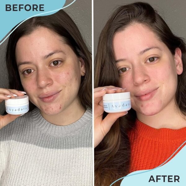 81P4BWj1OVL._SL1500_.jpg Warrior One (0.5oz) Acne Spot Treatment with 2% Salicylic Acid, Cystic and Hormonal Acne Cream, Acido Salicilico Acne Spot Treatment for Face, acne Cream for Adults and Teens, 150+ Uses