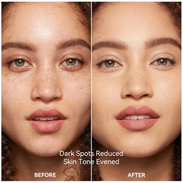 Dark Spot Remover for Face and Body Serum, Dark Spot Corrector for Freckles Melasma Age Spot Sun Spot Brown Spot for Women and Men, 1.7 Fl Oz