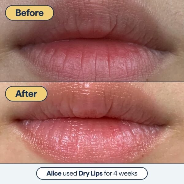 81eYdNiAPnL._SL1500_.jpg Remedy for Dry Lips - Hydrating and Healing Lip Balm Ointment with Ceramides, Peptides, and Dimethicone - Repairs Dry, Cracked Lips - By Dermatologist Dr. Shah