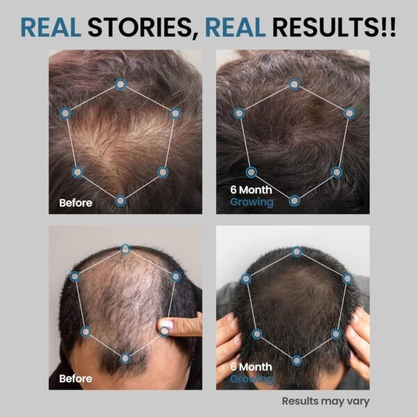 Hair Growth Oil for Men, Minoxidil 5% Hair Growth Serum Infused with Biotin, Extra Strength Hair Regrowth Treatments for Men to Combat Hair Loss