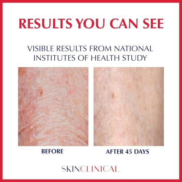 Extreme Healing, Non-Sticky, Fast-Absorbing Lotion For Dry Skin with Eczema and Psoriasis, Fragrance Free Lotion with Patented Ingredient SBD-4, Soothing Relief for Hand and Body, 3 Oz