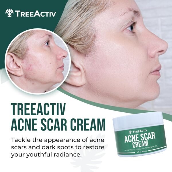 TreeActiv Acne Scar Treatment, 2 fl oz, Acne Scar Cream for Face, Gentle Acne Scars and Dark Spot Remover, Scar Lotion for Stretch Marks and Body Scars, Acne Scar Removal for All Skin Types, 500+ Uses