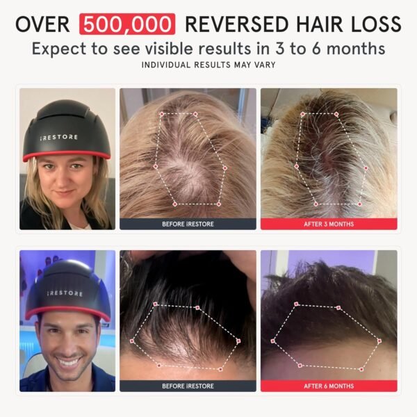 iRestore Elite - Laser Red Light Therapy for Hair Growth System - FDA Cleared Hair Loss, Hair Thinning & Alopecia Treatment for Men & Women - Laser Cap for Hair Regrowth Stimulates Denser Fuller Hair